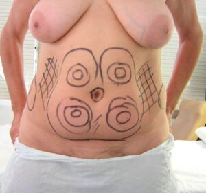 960731-dr-martinez-paris-jm-cirugia-de-abdomen-y-liposuccion-1