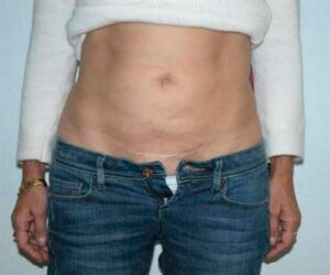 960732-dr-martinez-paris-jm-cirugia-de-abdomen-y-liposuccion-2