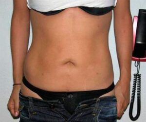 960734-dr-martinez-paris-jm-cirugia-de-abdomen-y-liposuccion-4
