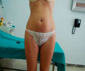 960736-dr-martinez-paris-jm-cirugia-de-abdomen-y-liposuccion-6