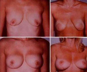 960772-dr-martinez-paris-jm-aumento-y-reduccion-de-mamas-12